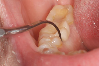 Diamond-coated tips allow removal of biofilm and solid deposits more thorough.
