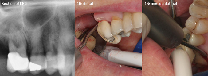 Closed debridement of the furcation on tooth 16 