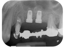 radiografía posoperatoria 