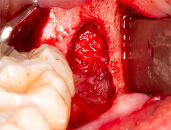 apical portion of the alveole