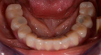 Implantes