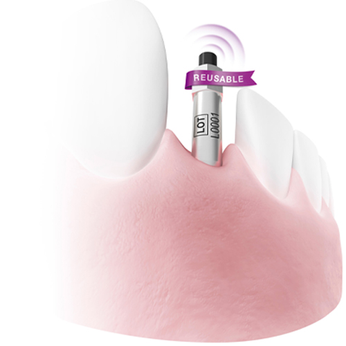 Illustration of a reusable Osstell SmartPeg in a denture, with a purple "reusable" flag.