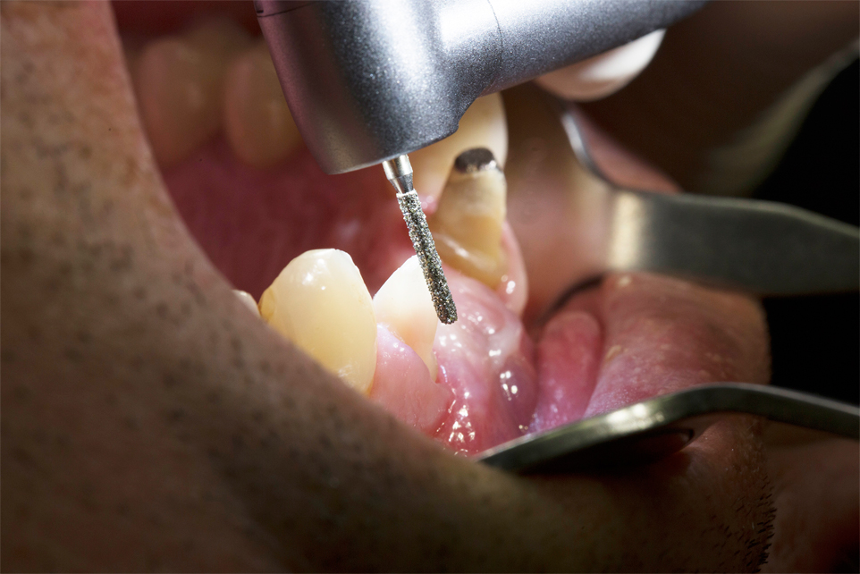 Preparación de cavidades y coronas