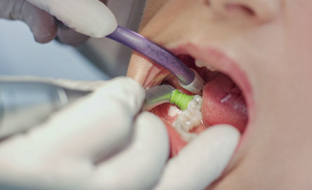 Selective polishing supports the process of remineralisation and eliminates the last bacterial recolonisation niches.