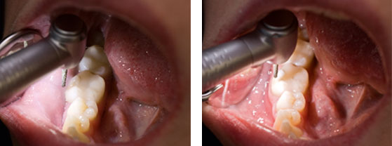 Comparación: LED y W&H con LED+