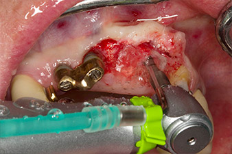 orificio piloto utilizando el nuevo Implantmed y el contra-ángulo WS-56 L