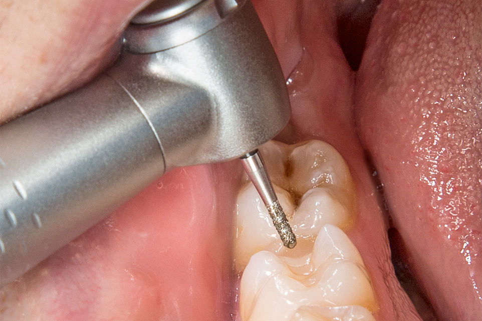 Removal of composite fillings