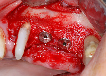 Xenogenes Knochenersatzmaterial 