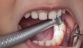 //a.storyblok.com/f/45617/5faa64992f/synea-vision-tk-94-led-mouth.png
