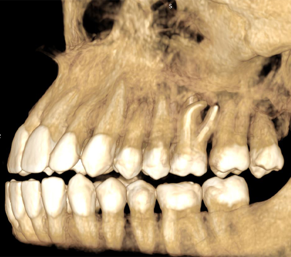 A jaw x-ray, in front of a black background.