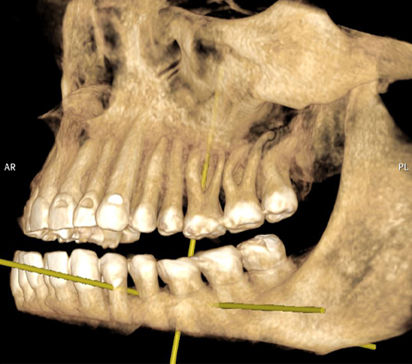 A jaw x-ray, in front of a black background.