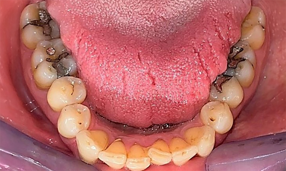 Occlusal view of the mandible showing the denture in situ.