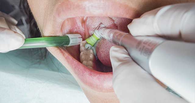 Comfortable polishing of hard-to-reach treatment sites.