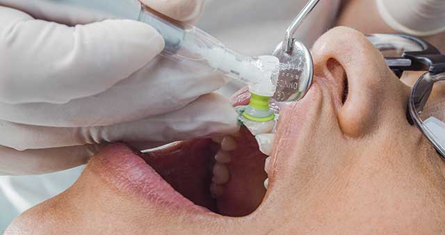 Il est possible de travailler directement sur le sulcus avec les contre-angles prophy jetables qui s’adaptent aux dents de façon optimale