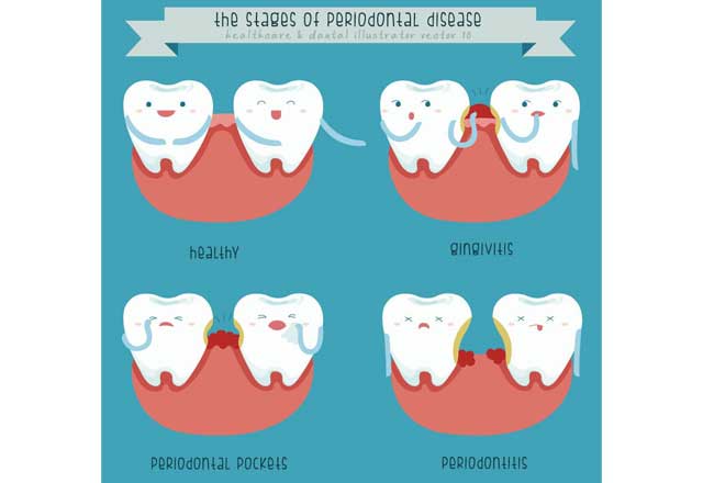 Klassifikation – Gingivitis