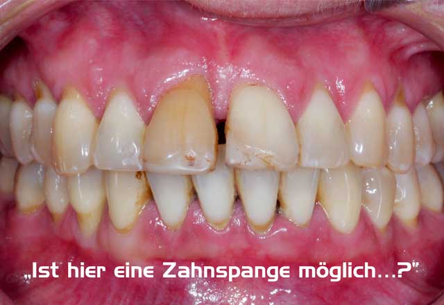 Orthodontic treatment of periodontitis patients – is such a thing possible ...?