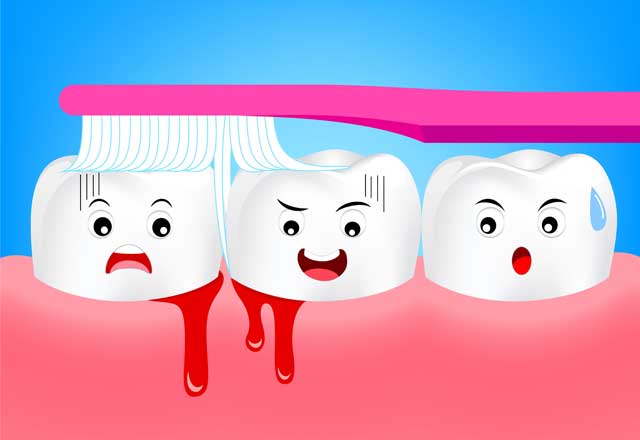 Klassifikation – Gingivitis