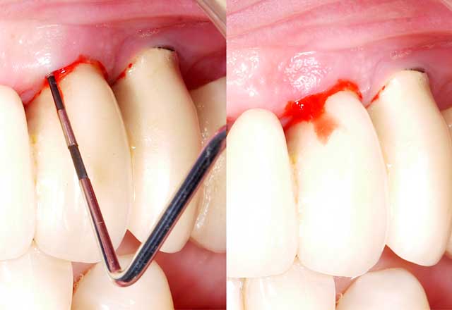 Peri-implantäre Mukositis richtig diagnostizieren!
