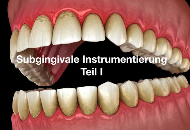 Subgingivale Instrumentierung – Teil I