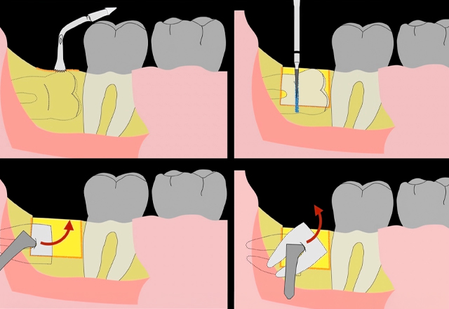 Piezo surgery: Simplified Extraction of third molars
