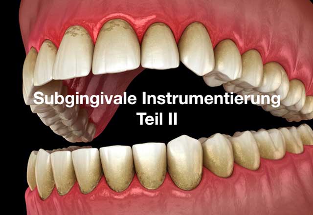 Subgingivale Instrumentierung – Teil II