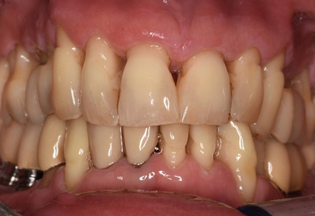 The healthy patient with pre-existing periodontal disease & peri-implantitis