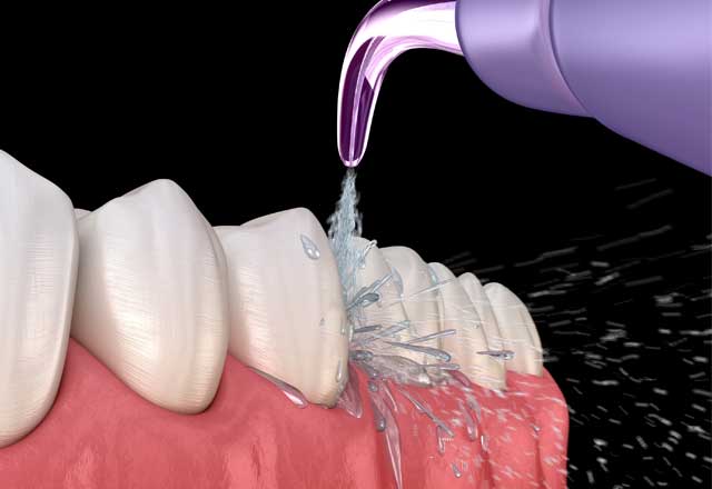 Interdentalraumbürste oder Munddusche?