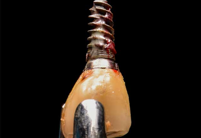 Peri-implantitis richtig diagnostizieren!
