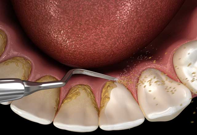 S3 guideline – Subgingival instrumentation