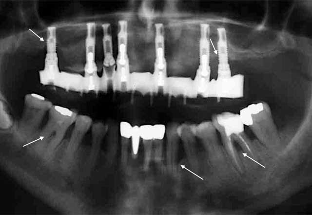 Periodontitis – is it a risk for peri-implantitis....?