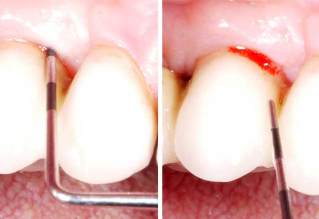 Unbehandelte peri-implantäre Mukositis …