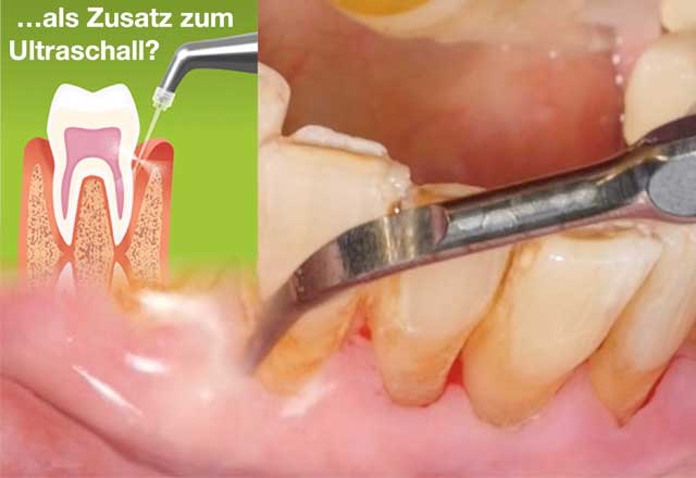 Pulverstrahl als Zusatz zum Ultraschall?