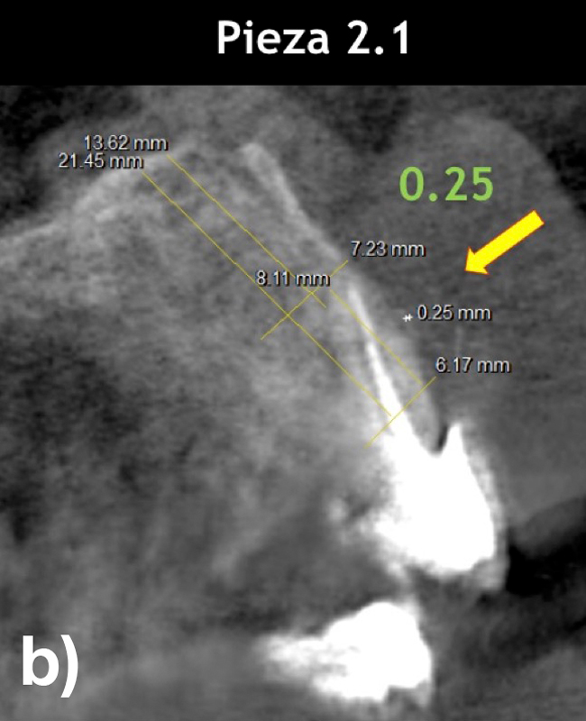 Figura: La radiografía revela cortes tomográficos sagitales de las piezas 1.1, 2.1, 2.2. con tablas óseas vestibulares bastante finas menores a 0.2 mm de espesor (a, c).