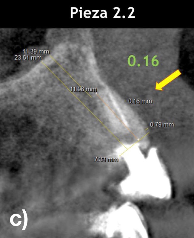 Figura: La radiografía revela cortes tomográficos sagitales de las piezas 1.1, 2.1, 2.2. con tablas óseas vestibulares bastante finas menores a 0.2 mm de espesor (a, c).