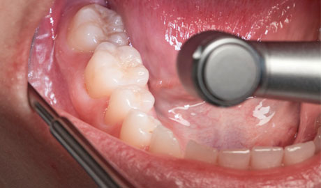 Illuminazione priva di ombre