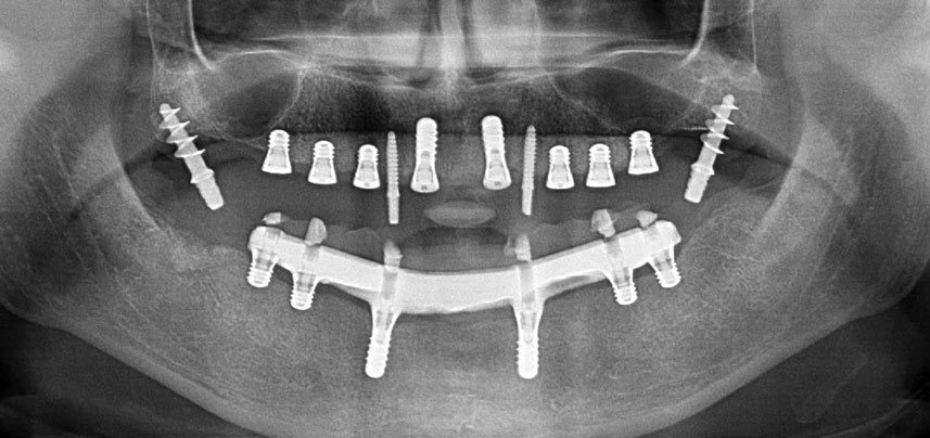 Postoperative Panoramaschichtaufnahme