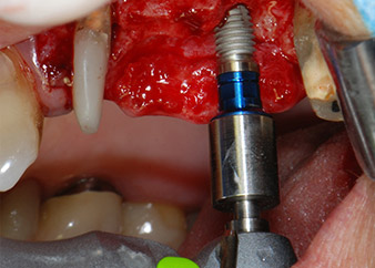 Low speed insertion of implant 26 
