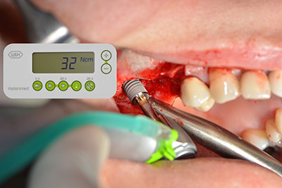 Implant placement