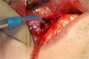 Fig: Disinfection with ozone gas 