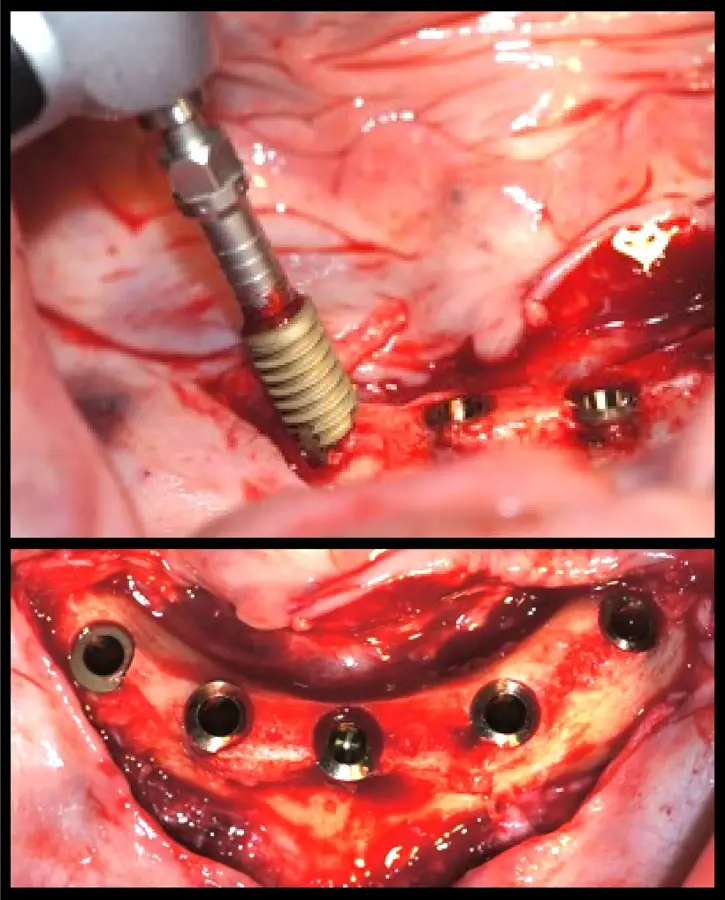 Colocación de implantes dentales