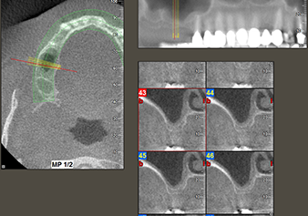 The DVT shows adequate dimensions in each of the axial (left), lateral (top) and transverse views (right) (right)