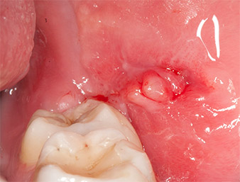 Condition after removal of sutures