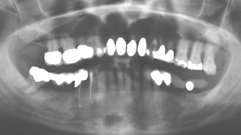 Fig. 1: Radiografia panoramica della situazione iniziale nel Panoramic radiograph of initial situation in 2004.