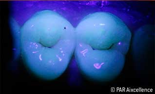 Abb 2: Ausleuchtung mit Facelight - hier aber im Sinne einer Durchleuchtung, um Opazitäten zu erahnen. Bei dieser Form der Ausleuchtung findet keine Aktivierung der Porphyrinverbindungen statt.