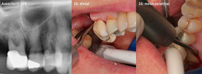 Geschlossenes Debridement der Furkation an 16
