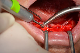 residual dentition 