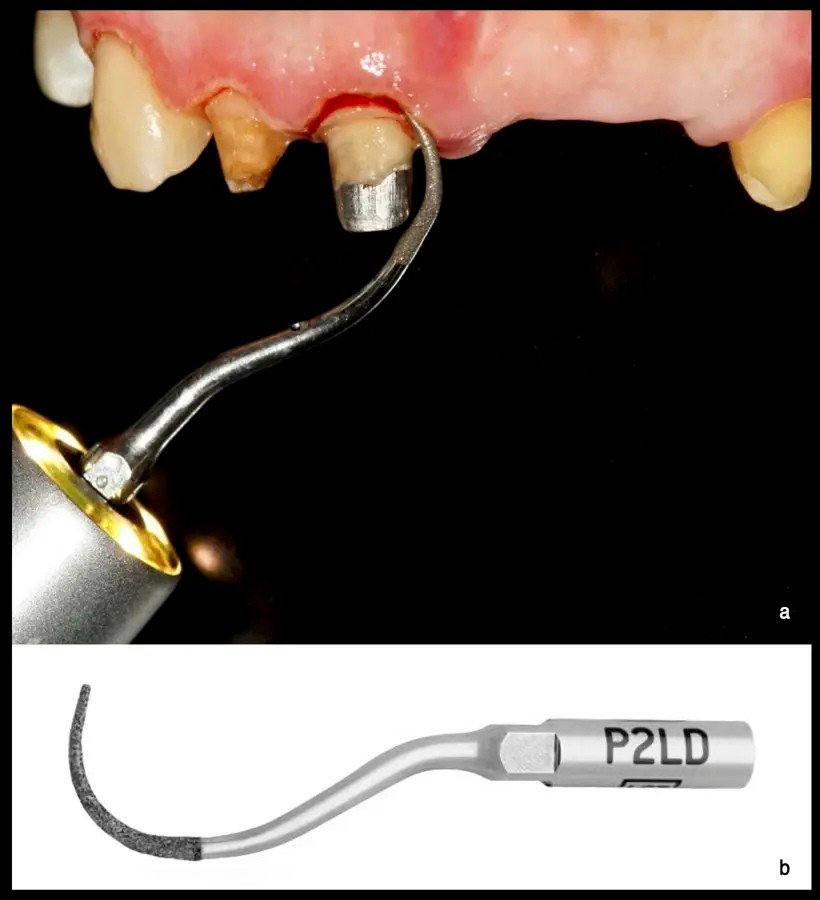 Recontorneo gingival