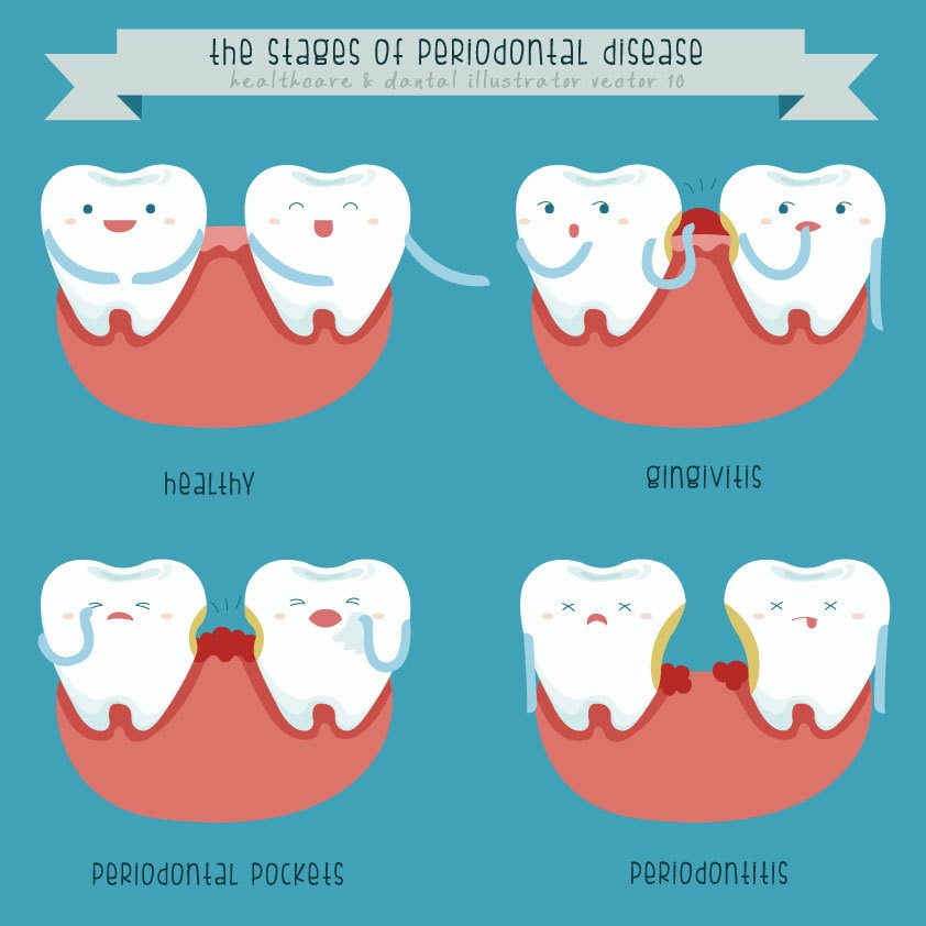 Classification of gingivitis (Shutterstock)