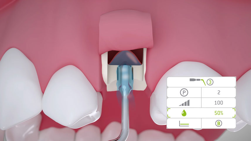 The Z35P is also suitable for the hydrodynamic elevation of the Schneiderian membrane in the scope of the internal sinus lift