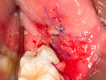 suture (filo in Vicryl 4.0)